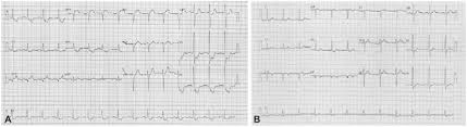Typical ecg findings include the presence of p waves and qrs complexes that have no association with each other, due to the atria and ventricles functioning independently. Pre And Post Procedure Resting 12 Lead Ecg A Admission Ecg Showing St Download Scientific Diagram