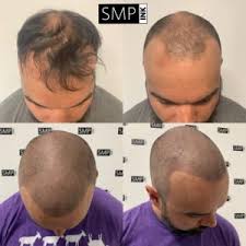 Other common causes of hair loss include the overuse of damaging hair products or tools like blow dryers and other appliances that heat the hair. Male Or Female Pattern Baldness Smp Ink