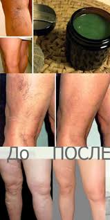 чем лечить варикозное расширение вен на ногах в домашних условиях Mama Izbavilas Ot Varikoznogo Rasshirenie Ven S Pomoshyu Prostogo Recepta Ot Babushki Rezultaty Vidny Zdorove Varikoz Lechenie Ruk