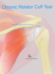 Image result for Rotator Cuff Injury