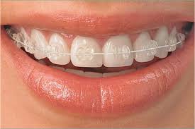 Do Braces Have Side Effects? | Disadvantages Of Wearing Teeth Braces -  Rejové32 Aligners