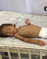 Gazze’de 2 yaşındaki İmad, açlık nedeniyle vücut ağırlığının yarısından  fazlasını kaybetti, İsrail’in açlığa mahkum ettiği küçük çocuk yaşam  mücadelesi veriyor, #anadoluajansi #anadolu