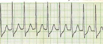 Psvt causes the heart to beat too quickly—during psvt episodes, the heart can race and jump from the normal 60 to 100 beats per minute, … Adenosine Versus Intravenous Calcium Channel Antagonists For Supraventricular Tachycardia Itjem