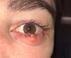 When someone has conjunctivitis, the clear layer covering the white part of each eye and the inner lining of each eyelid become inflamed. Cluster Of Chalazia In Nurses Using Eye Protection While Caring For Critically Ill Patients With Covid 19 In Intensive Care Occupational Environmental Medicine