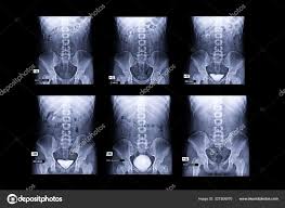 Image result for Intravenous Pyelogram