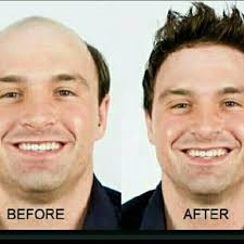 Baldness makes a person look unattractive and aged. Hair Fixing In Bangalore Hair Weaving Service Hair Apparent Clinic