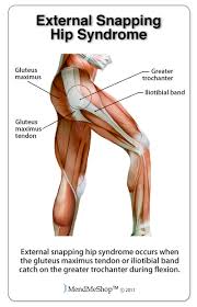 Dancers How To Fix A Clicking Hip Snapping Hip Syndrome Sport Spinal Physiotherapy