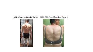 Subcutaneous Adipose Tissue Diseases Dercum Disease Lipedema Familial Multiple Lipomatosis And Madelung Disease Endotext Ncbi Bookshelf