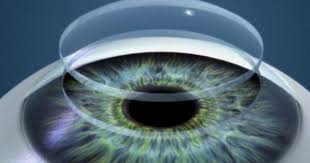 Gözün ön kısmında yer alan kornea, görme duyusuna önemli katkılar sağlar. Kornea Nedir