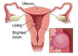 See full list on radiopaedia.org Understanding Blighted Ovum Saint Luke S Health System