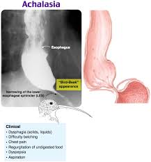 Achalasia Medical Knowledge Medical Intern Nursing Mnemonics