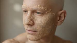 Image result for Ichthyosis