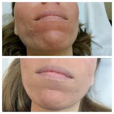 Check spelling or type a new query. Fractional Laser Scar Treatment Services Skin Resurfacing