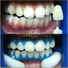 Klinik pergigian azura, johor bahru, johor, malaysia. Klinik Pergigian Dental Legacy Bandar Dato Onn Startseite Facebook
