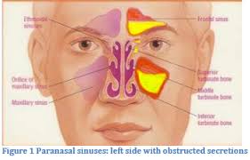 This is usually performed as outpatient surgery (the patient goes home the same day) with one week of recovery time where vigorous physical activity should be avoided. Endoscopic Sinus Surgery
