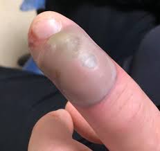 It usually occurs on fingers. Woman S Chilling Warning To Nail Biters After Friend Contracts Deadly Infection Mirror Online