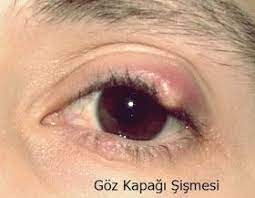 Goz Kapagi Sismesi Gozler