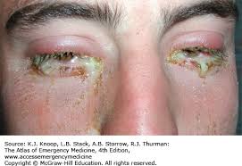 Image result for Gonococcal Conjunctivitis