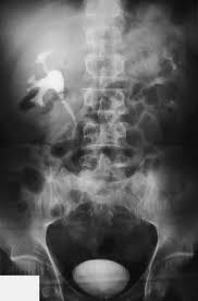 Image result for Intravenous Pyelogram