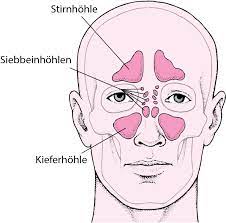 Die nasennebenhöhlen (nnh, sinus paranasales) sind luftgefüllte räume. Nasennebenhohlenentzundung Hals Nasen Und Ohrenerkrankungen Msd Manual Ausgabe Fur Patienten