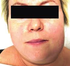 Image result for phlegmon on face)