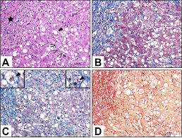 If you are a chronic alcohol user, you should take steps to learn how to cleanse your liver from alcohol before damage. Fibrosis And Alcohol Related Liver Disease Journal Of Hepatology