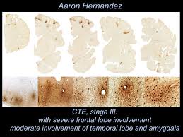 Sanjay gupta explains the causes and symptoms of chronic traumatic encephalopathy, more commonly known as cte. New Images Show Aaron Hernandez Suffered From Extreme Case Of Cte Nfl The Guardian
