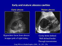 Medical School Medical Ultrasound Abscess In Kidney In 2020 Ultrasound Medical Ultrasound Diagnostic Medical Sonography