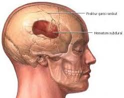 Rasa sakit kepala macam menyucuk2 otak diiringi dengan senak pada mata. Sukses Mengatasi Sakit Kepala Sebelah Kanan