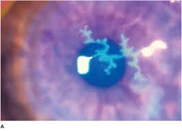 24, 2020 herpes keratitis is a viral infection of the eye caused by the herpes simplex virus (hsv). Corneal Infections Inflammations And Surface Disorders Ento Key