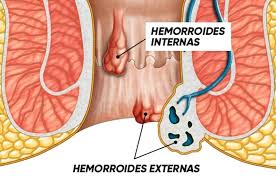 Banding Hemorroidal