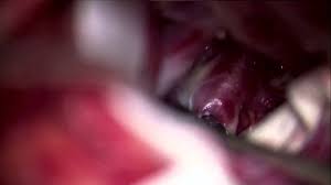 Microsurgical Clipping Of An Unruptured Basilar Apex Aneurysm Youtube Johns hopkins' aneurysm center offers you a range of treatments, including newer, less invasive therapies, so your neurosurgeon can recommend the procedure most appropriate for your individual.