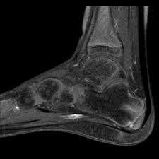 Image result for Calcaneal Apophysitis