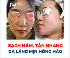 ĐIỀU TRỊ NÁM, TÀN NHANG