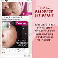 Parut berlubang dan lebam boleh hilang dengan berkesan. Tips Rawatan Parut Berlubang Tanpa Laser T9 Skincare