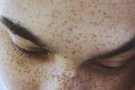 Image result for Freckled skin