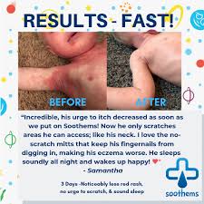 Eczema Sleepsuit For Babies Sleepwear For Itchy Sensitive Skin Soothems What do customers think of soothe? usd