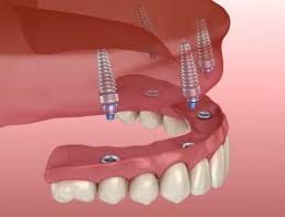 Mini dental implants run between $500 and $1500 each and are not as wide as traditional implants, therefore they are not appropriate for bigger cases. How Many Teeth Can Dental Implants Replace