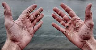 Wash your hands and the blister. Rowing Blisters 101 Blisters Suck This We Can All Agree By Kayleigh D Medium