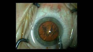 The surgeon will work with very fine instruments while looking at your eye through a microscope. Routine Cataract Surgery In Real Time With Narration By Shannon Wong Md 4 30 2011 Youtube
