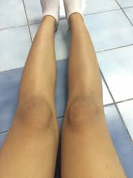 ซีม่า โลชั่น มันคือยาอะไร ขนาดทาแค่เข่ายังดำไหม้ ไขปริศนา ซีม่า ไม่ใช่โลชั่น ทาแล้วอันตราย หลังเด็ก ป.2 โดนราดทั้งตัว จนแผลพุพอง เพราะราด. Girlstalkthai On Twitter à¸‹ à¸¡ à¸²à¹‚à¸¥à¸Š à¸™ à¸šà¸—à¹€à¸£ à¸¢à¸™à¸£à¸²à¸„à¸²à¹à¸žà¸‡ Http T Co Tq1nlo59gh Http T Co Xgrediucsq