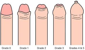 Image result for Phimosis