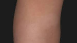 Classically, it begins with a single red and slightly scaly area known as a herald patch. Pityriasis Alba Altmeyers Encyclopedia Department Dermatology