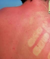 Der Systemische Lupus Erythematodes Sle