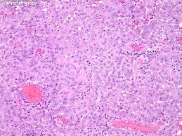 Sarcomatoid histology on biopsy was found to have the highest correlation with resection histology, followed by biphasic and epithelioid. Webpathology Com A Collection Of Surgical Pathology Images