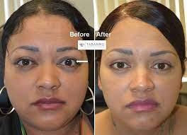 Graves Disease Thyroid Eye Disease Orbital Decompression Bulgy Eye Surgery Photos Mehryar Ray Taban Md