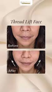 Cantik itu bukan soal umur, tapi cara kamu merawat diri🥰, Dengan  threadlift, kulit wajah kembali kencang dan percaya dirimu makin bersinar  ✨, Yuk, book appointment Threadlift Face di Jiang Clinic❤️, 📲 ...