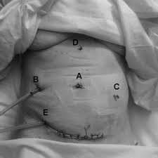 Check spelling or type a new query. Scars After Surgery For A Open Left Lateral Sectionectomy And B Download Scientific Diagram