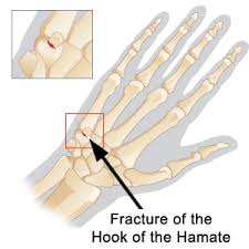 Image result for Hamate Bone