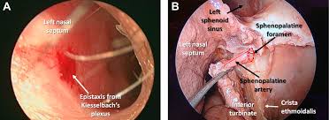 Image result for Epistaxis
